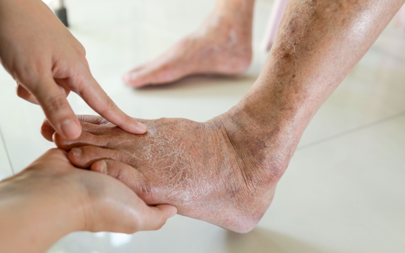 Kaki Diabetes : Ciri-ciri Penyakit Gula pada Kaki 